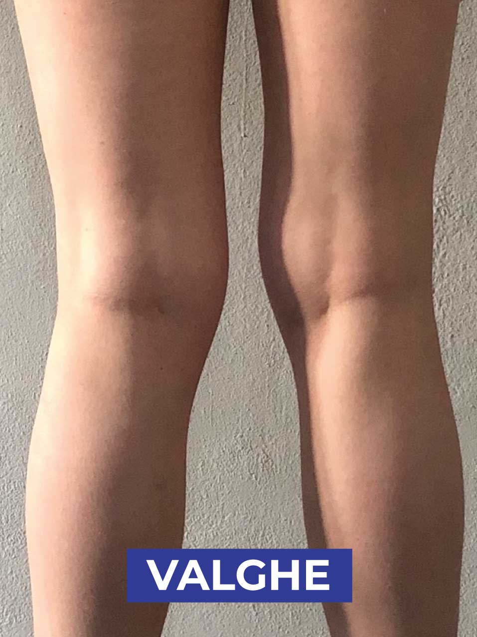 ginocchia VALGHE_1-1