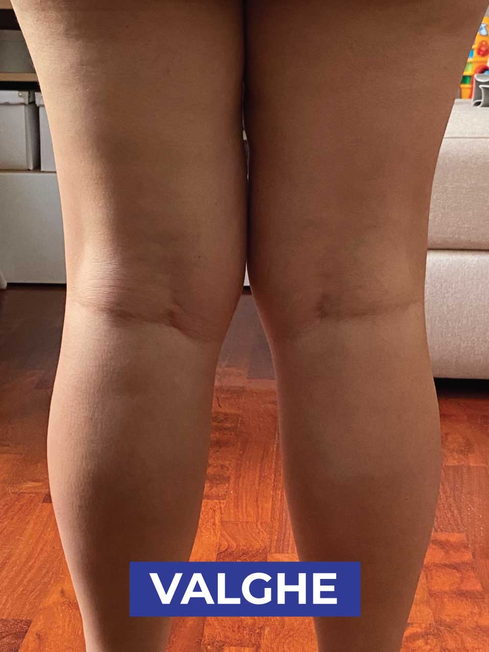 ginocchia VALGHE_2-1