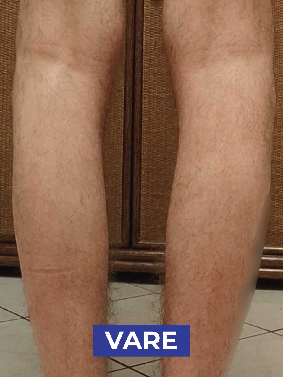 ginocchia VARE_1-1