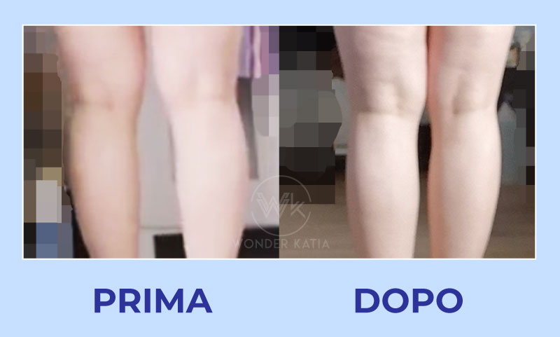 prima dopo ginocchia 1