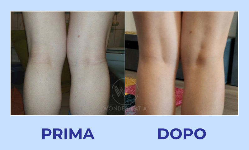 prima dopo ginocchia 2