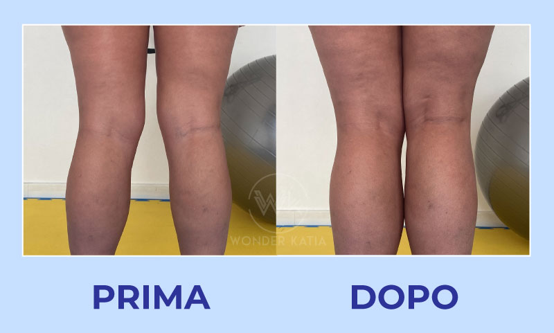 prima dopo ginocchia 3